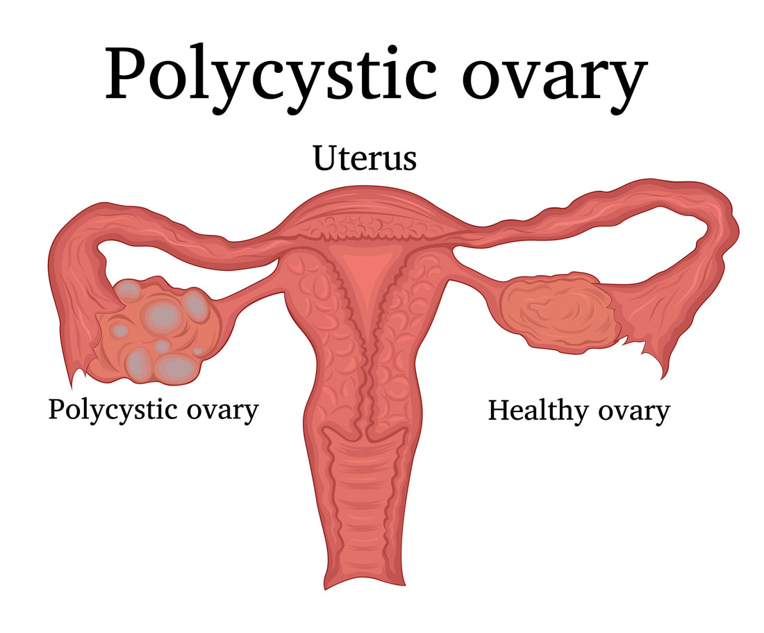 Pcos and natural remedies 